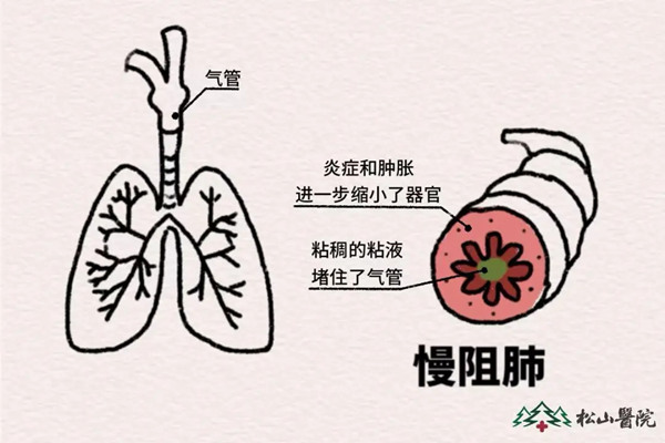 示意圖。重慶松山醫院供圖